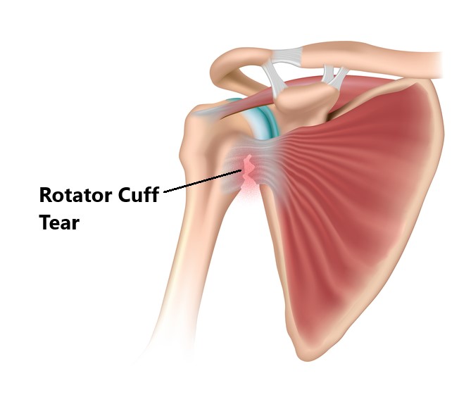 rotator-cuff-tear-ssc